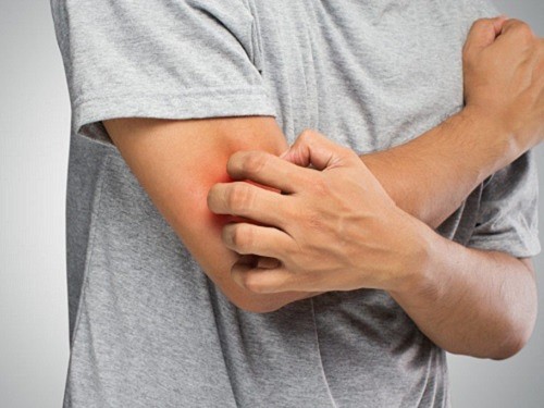 Обострение аллергии весной зуд при аллергии